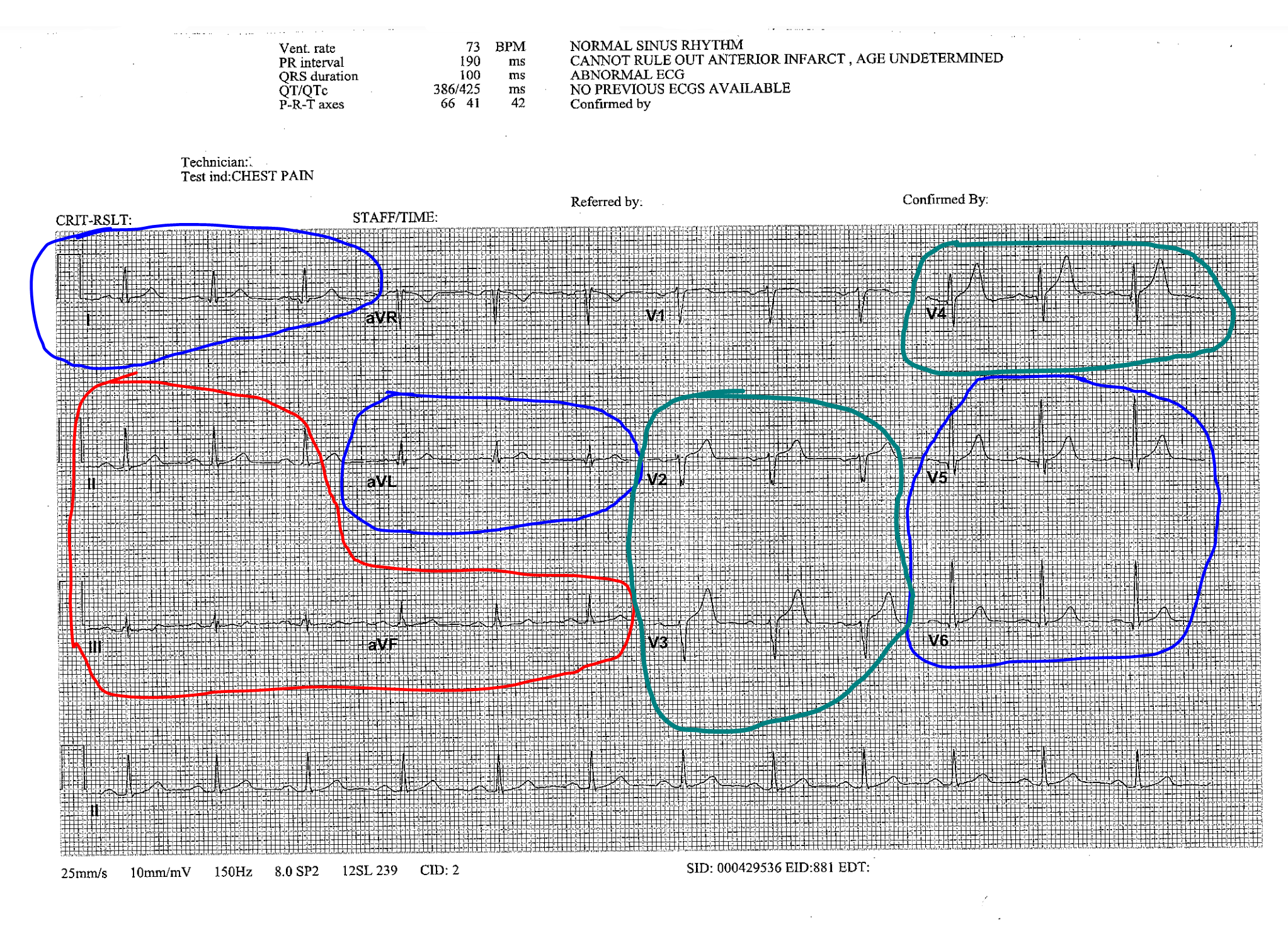 How Much To Know About The 12 Lead ECG Nursing Priorities