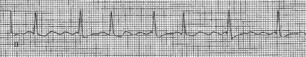 How Much To Know About The 12 Lead Ecg Nursing Priorities